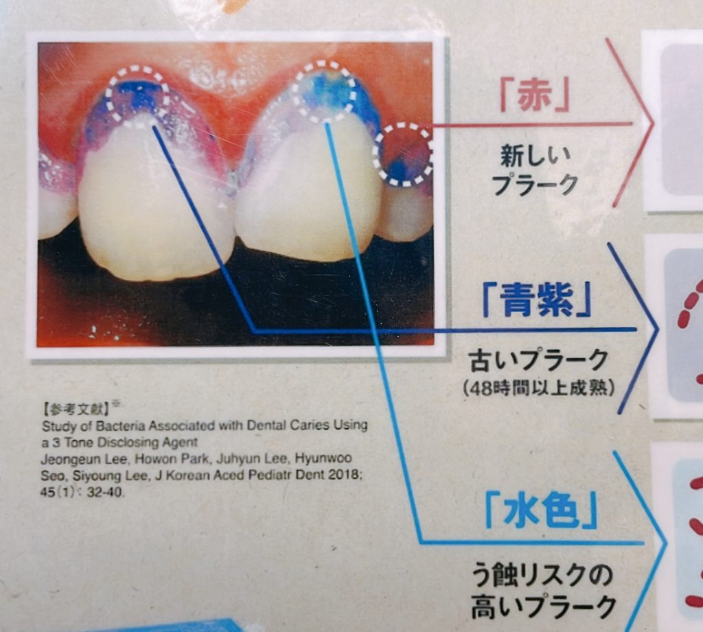 プラークを染め出してみよう‼️ - 広島市西区の歯医者「おおつぼ歯科クリニック」